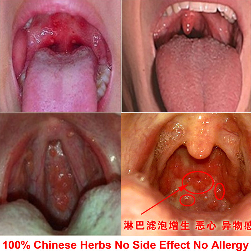 100% Organic Chinese Herbs Pastilles Sore Vocalzone Throat Stop Cough Anti Coughing Cold Dry Mouth Repair Damaged Liquify Phlegm